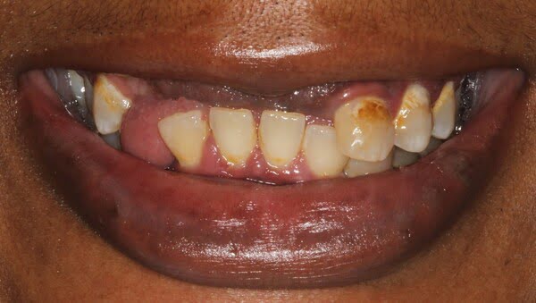 Case 9, All-on-4 dental implants: smile before treatment by prosthodontist Dr. Esam Nahlah, Northern Virginia