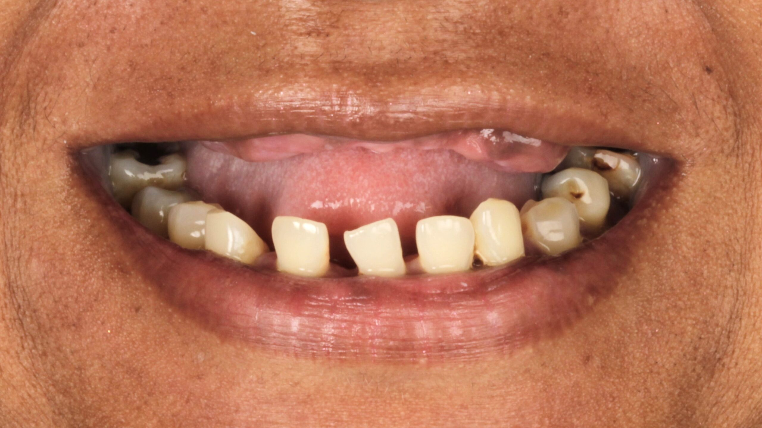 Case 26, double-arch All-on-4: smile before treatment by prosthodontist Dr. Esam Nahlah, Northern Virginia