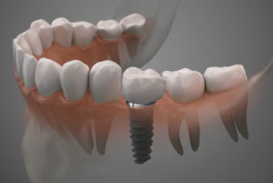 dental implants graphic.