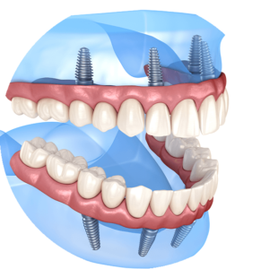 all-on-4 dental imlpants