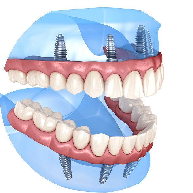 all-on-4 dental imlpants