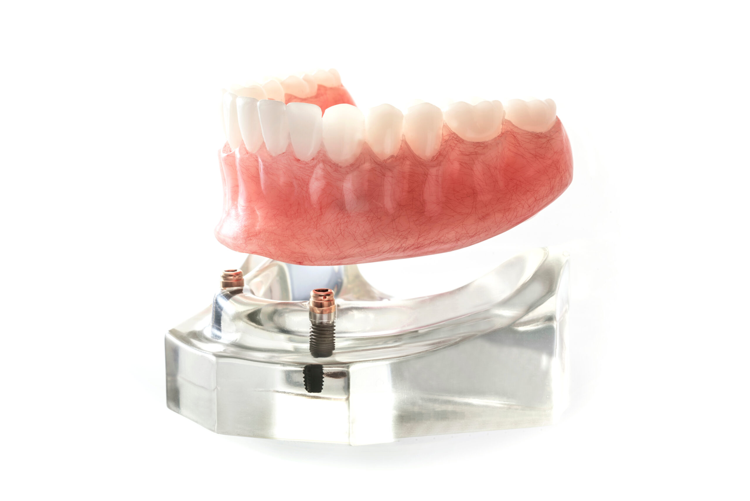 an image of a implant supported denture.