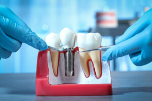 Dentist with tools pointing at dental implant between teeth in educational model indoors, closeup