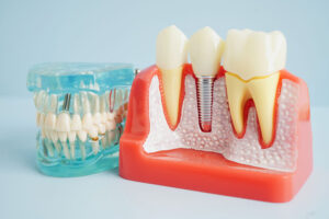 a full arch of teeth next to a cut away of the jaw showing an implant