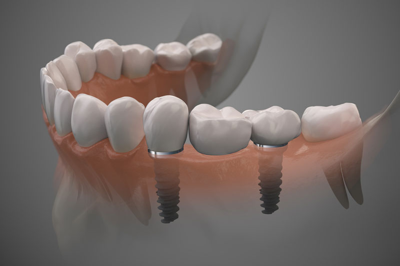 2 single dental implants placed into the jaw with a crown on top