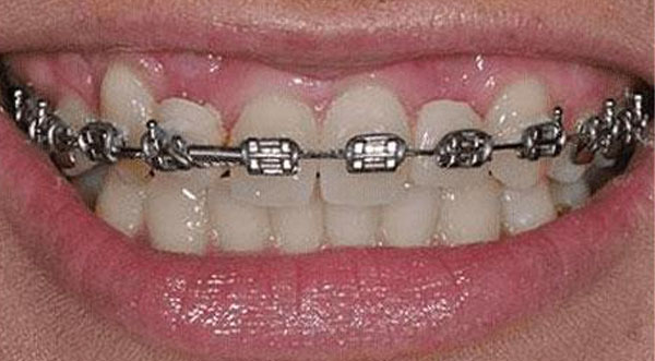 case-1-dental-implants-before