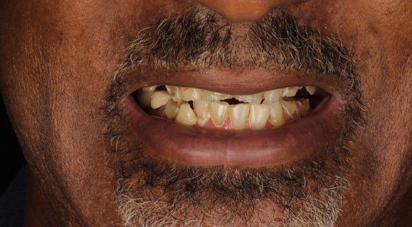 case-3-all-on-4-implants-before case-3-all-on-4-implants-before