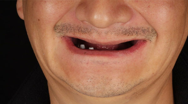 case-4-all-on-4-implants-before case-4-all-on-4-implants-before