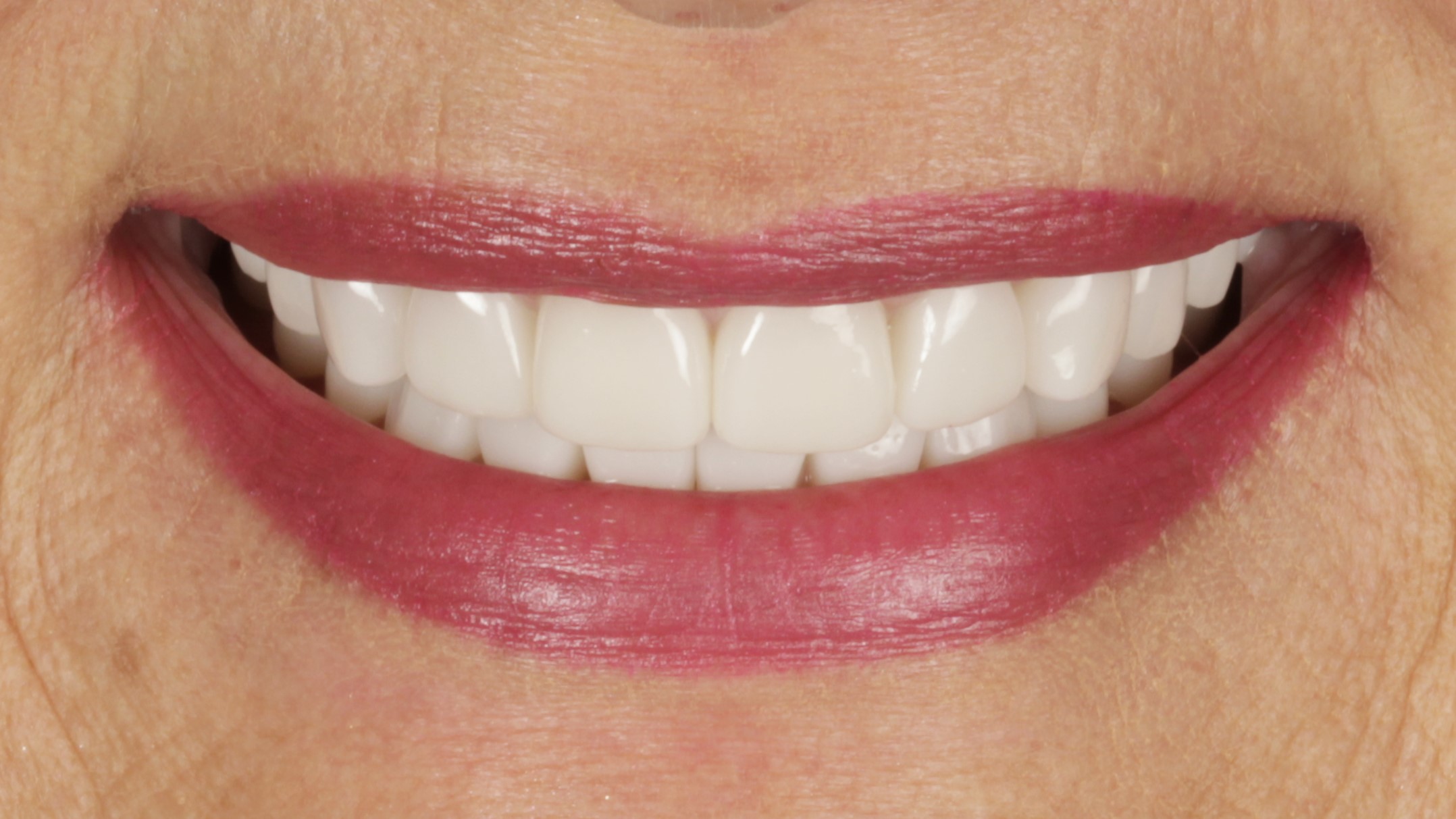 1-Veneers after