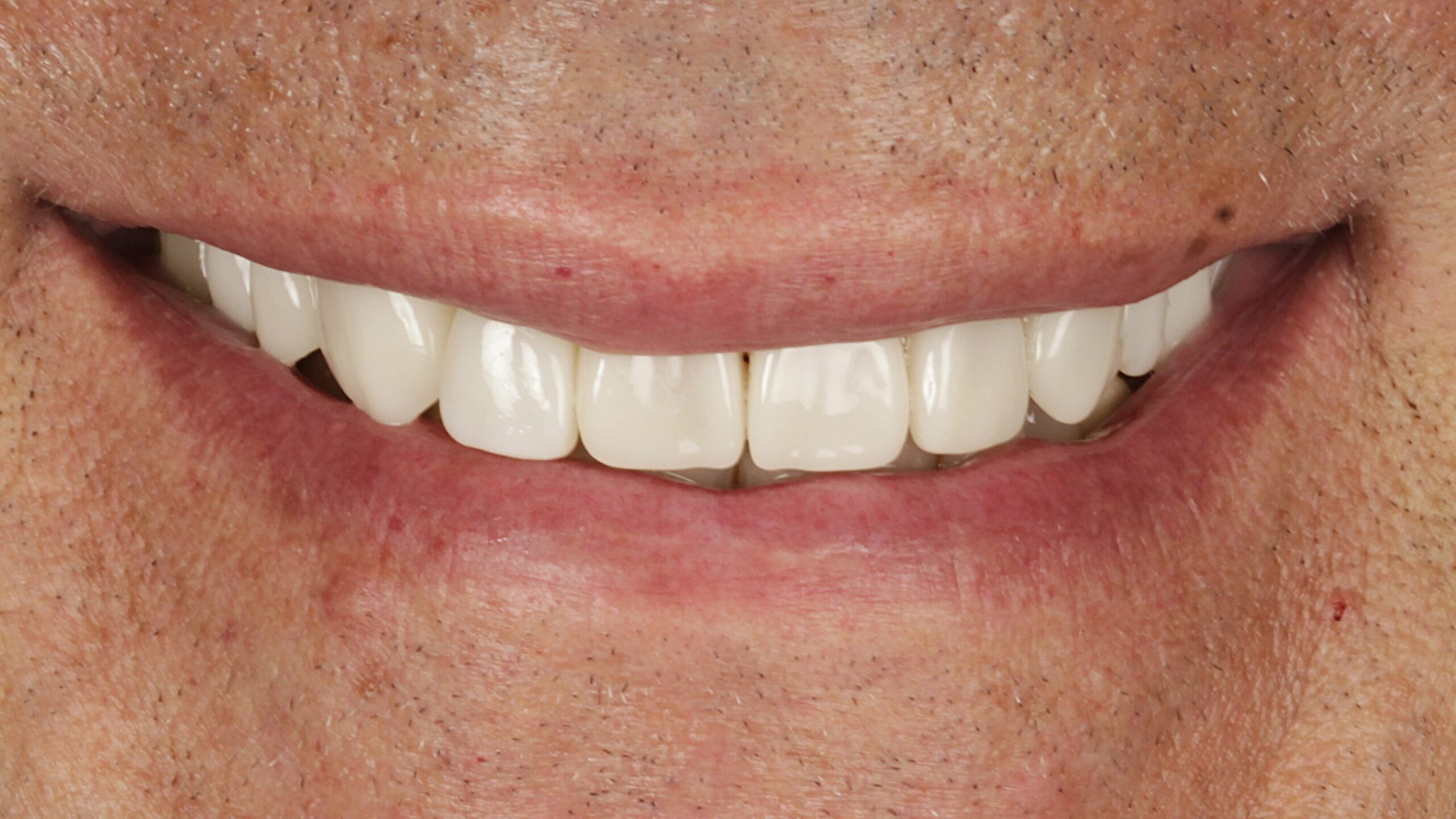 1-Veneers and Implants after