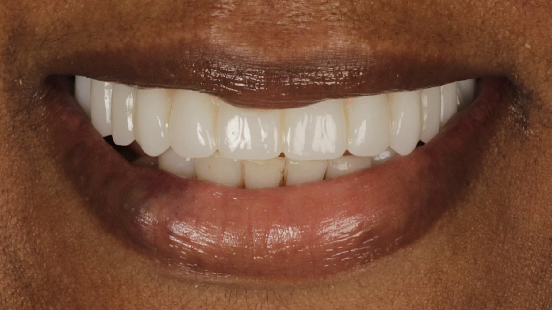 2-Single AO4 After