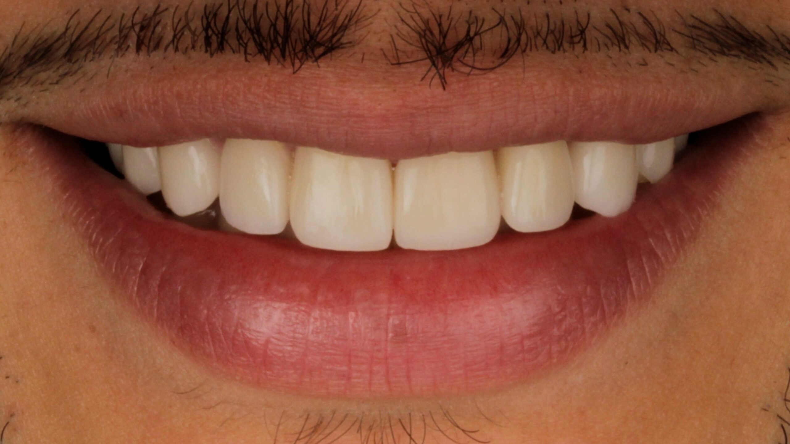 2-Veneers after