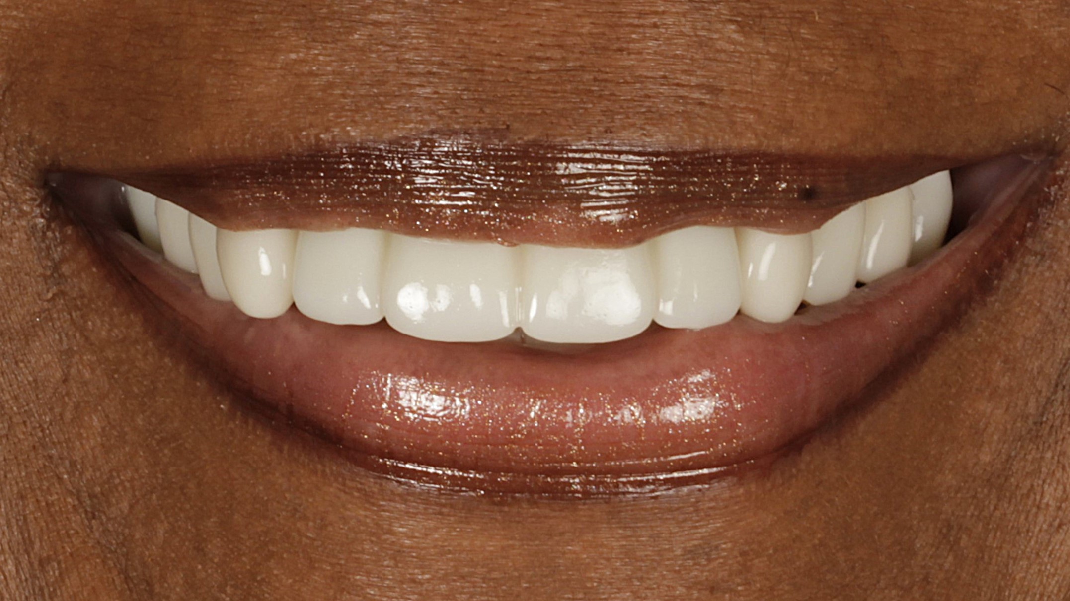 2-Veneers and Implants after