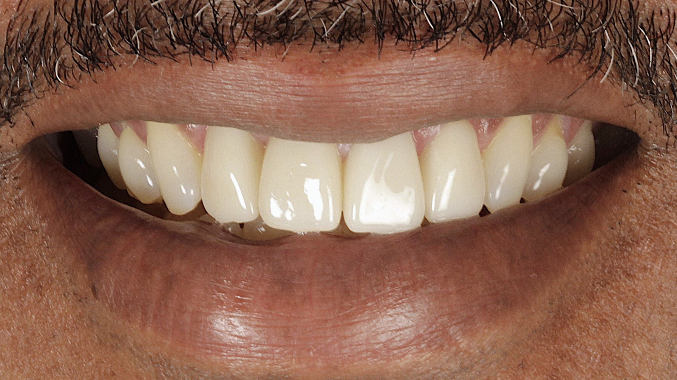 3-Veneers and Implants after