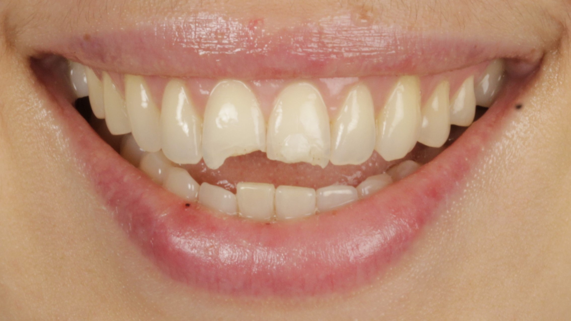 3 Veneers before 3 Veneers before