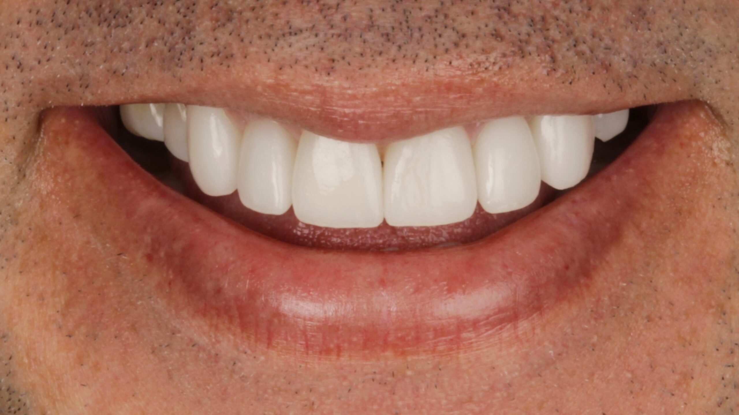 4-Veneers after