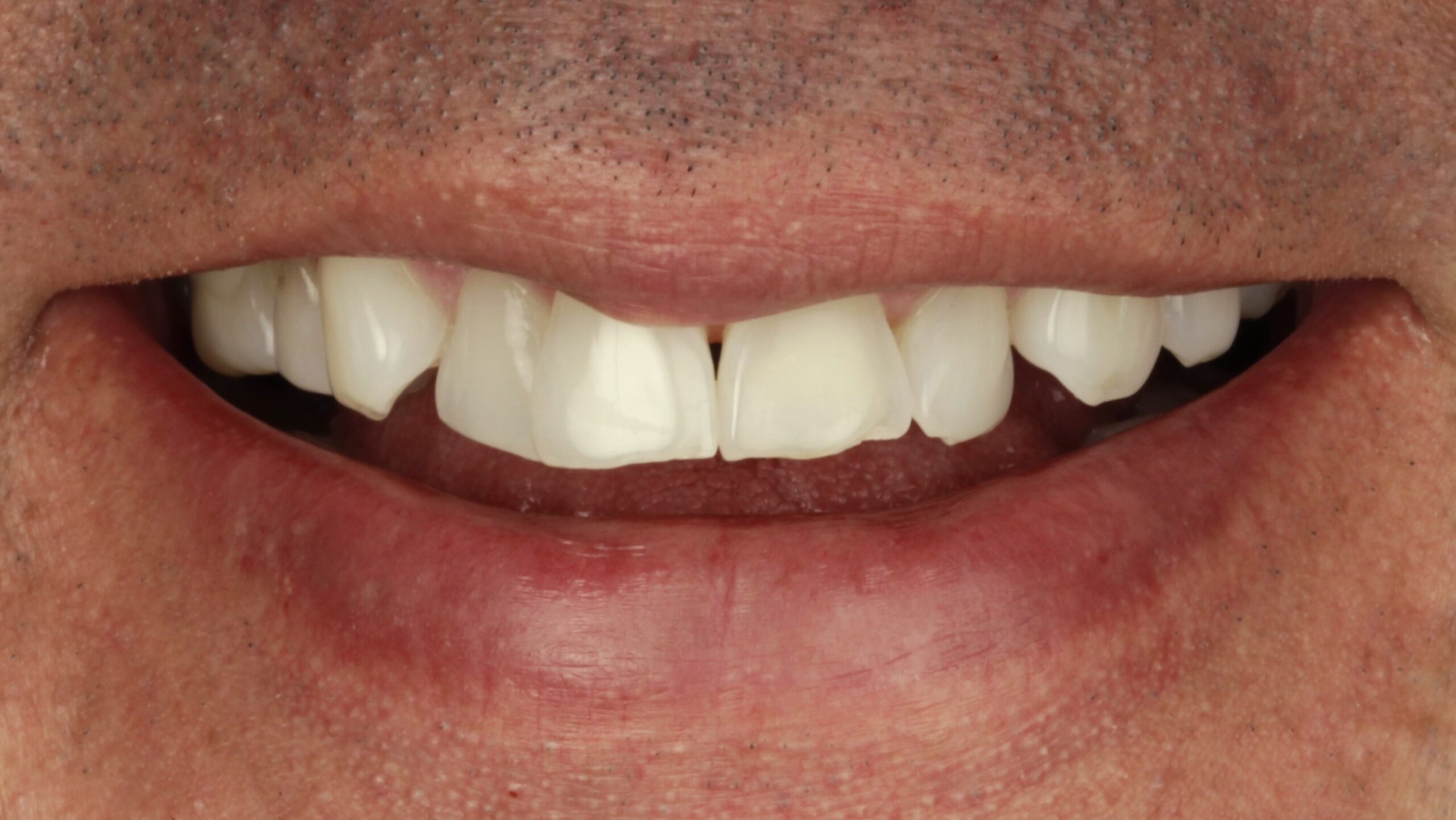 4 Veneers before 4 Veneers before