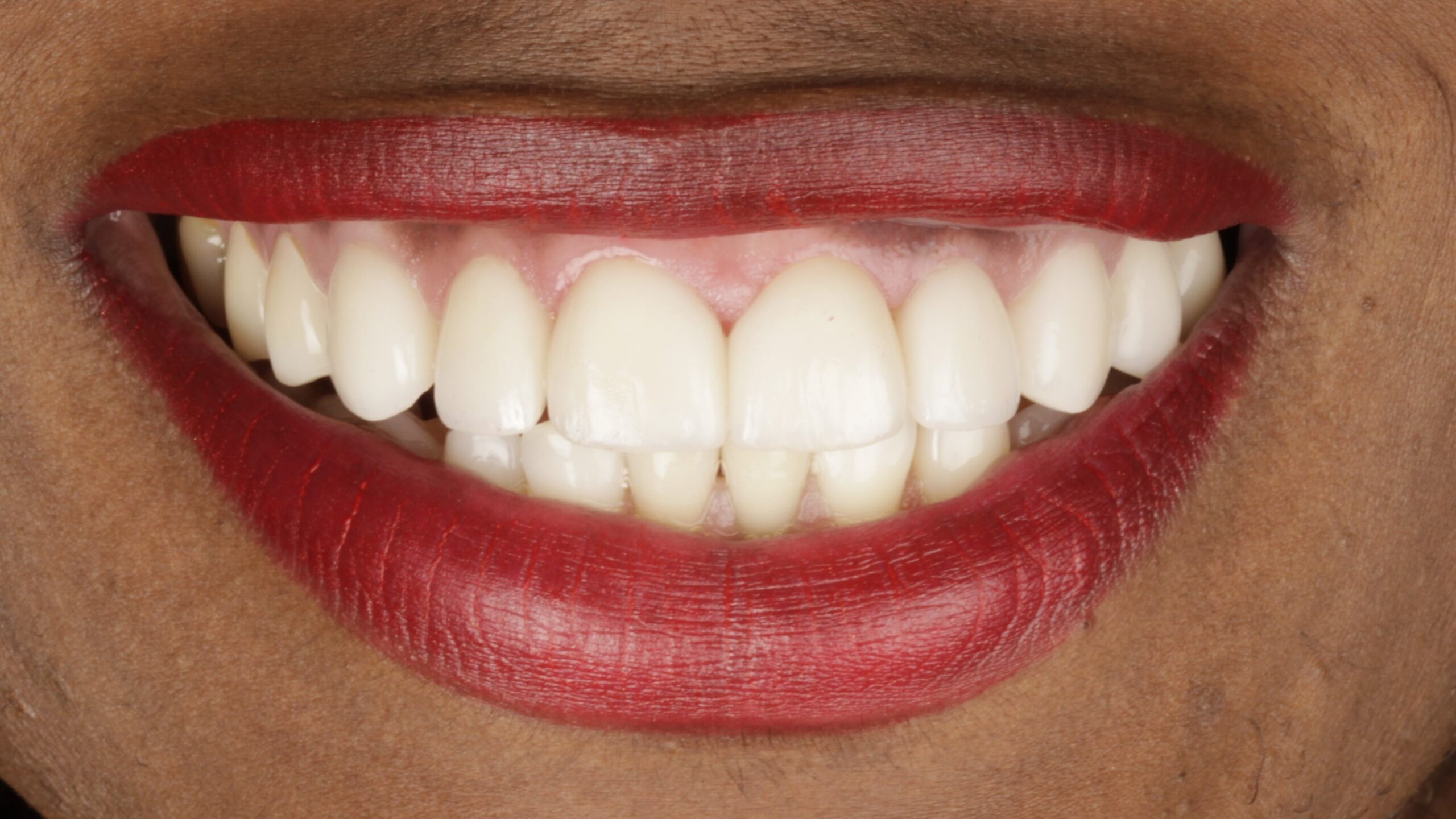 5-Veneers after