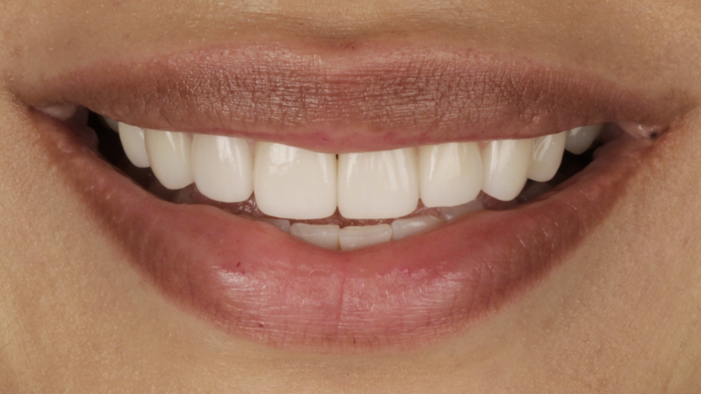6-Veneers after