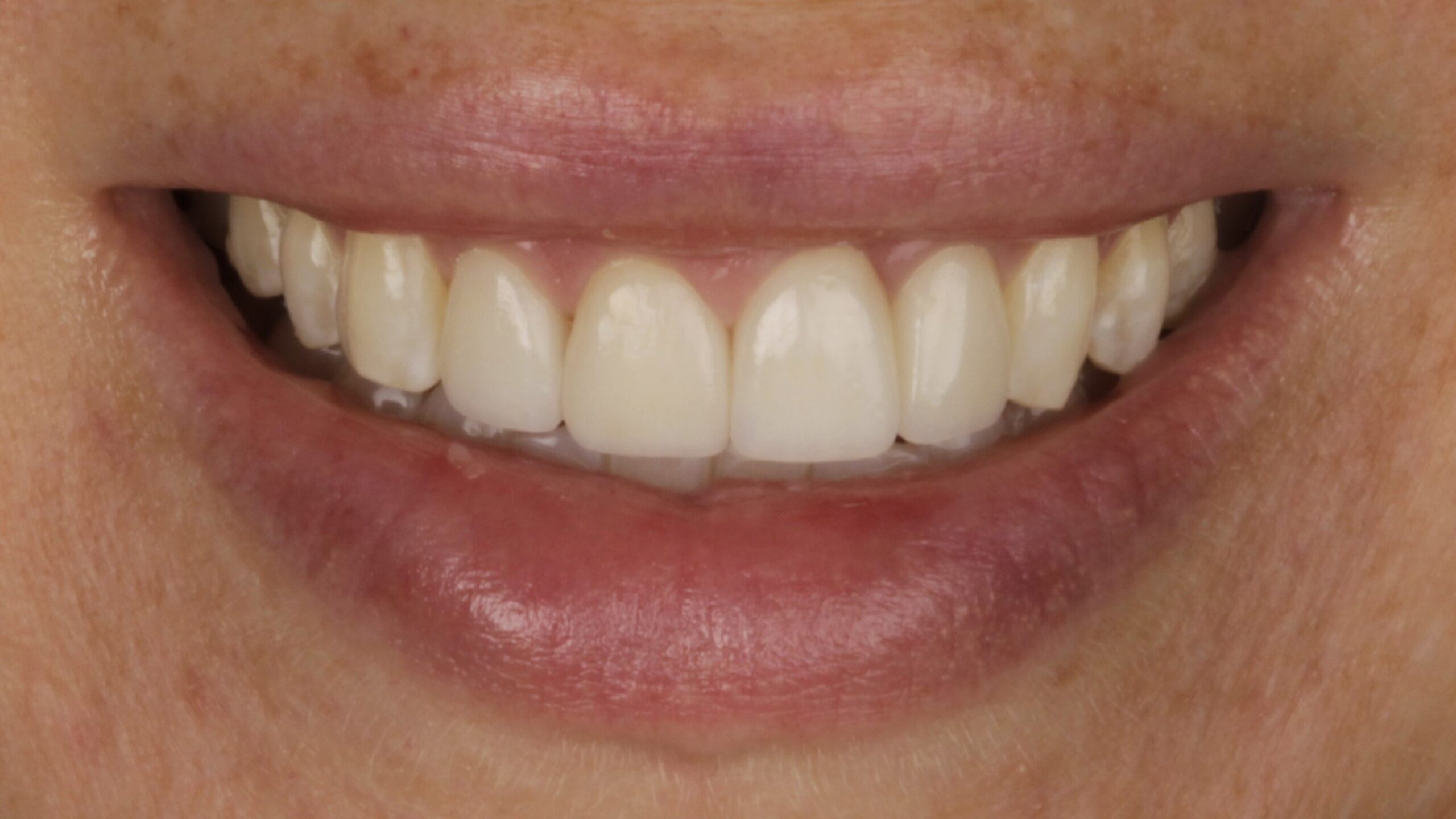 7-Veneers after